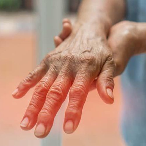 Peripheral Neuropathy